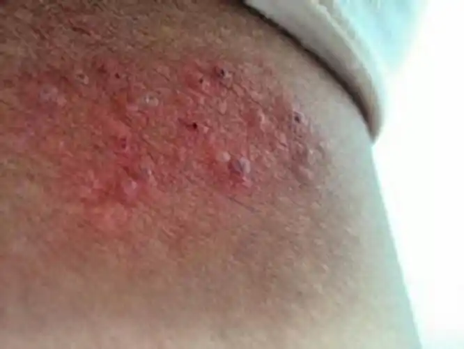 早期梅毒感染症状图图片