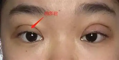 割双眼皮失败割双眼皮失败案例图片2022已更新今日更新