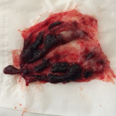 这个胎囊能看出男孩女孩吗?