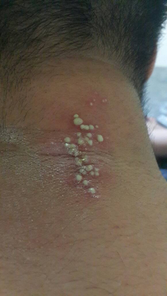 痱子亦称粟粒疹,为夏季或者炎热环境下常见的一种表浅性,炎症性皮肤病