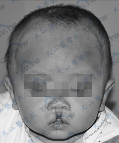 唇裂儿童的护理