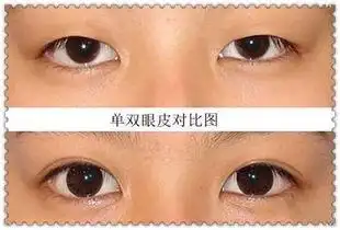 单眼皮和双眼皮的区别