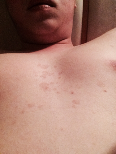 胸口和肚子上有斑比皮肤颜色深一些,是怎么回事,不痛不痒