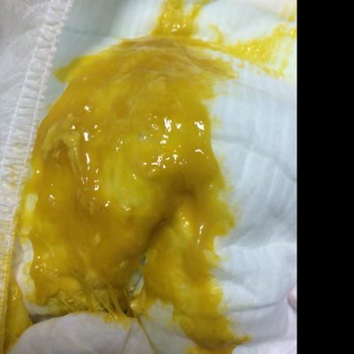 有图慎入…宝宝大便稀水样,黄色,有絮状物和黏液是怎麼回事?急!