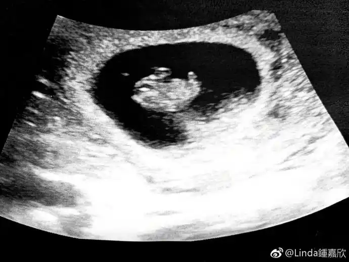 钟嘉欣二胎b超图