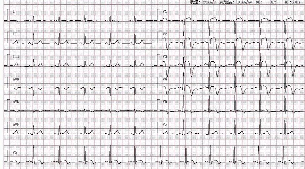 典型心电图急性心肌梗死没有基础也能一看就懂