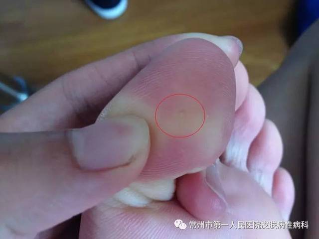 别再傻傻的鸡眼,跖疣分不清啦!