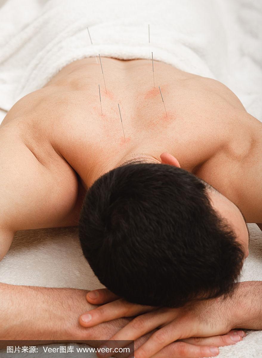 一名背部有针灸针的男子正在一家中医诊所接受治疗.针特写