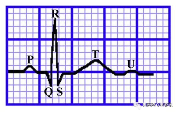 「临床实用心电图入门」第二讲:心电图导联,波形及临床价值