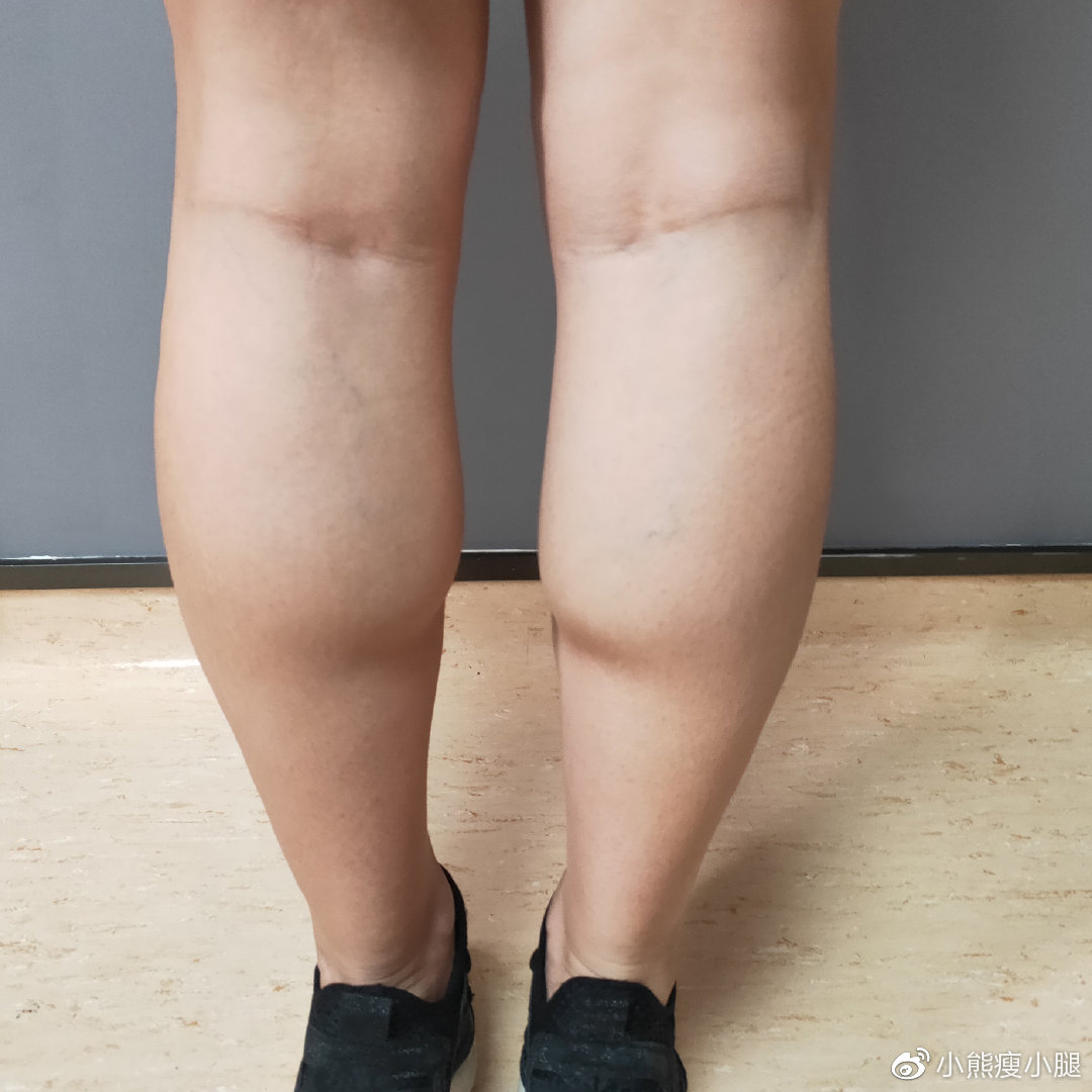 坐标杭州在北京做了神经阻断术瘦小腿肌肉老阿姨也可以拥有少女腿