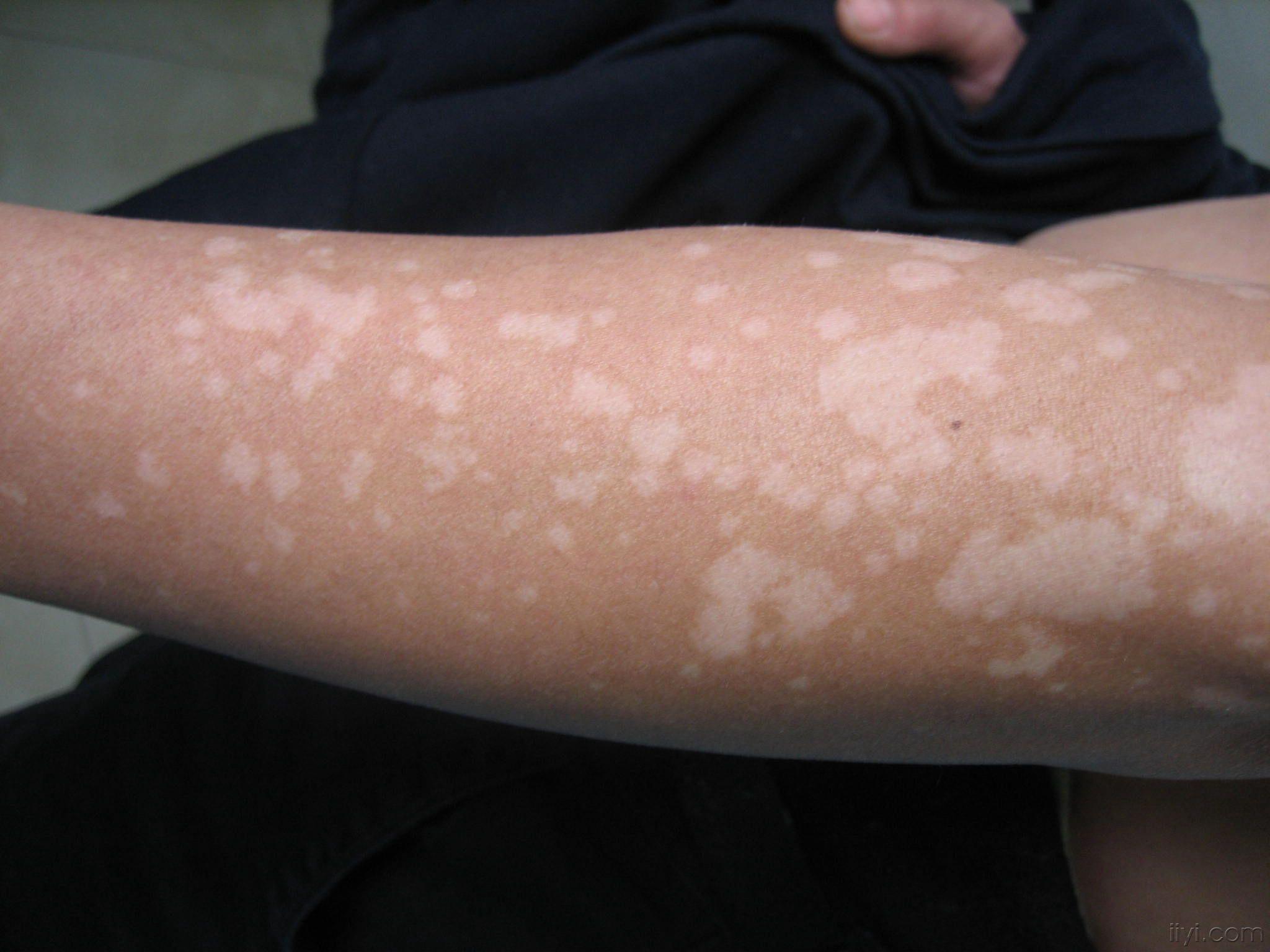 看看漂亮的花斑癣