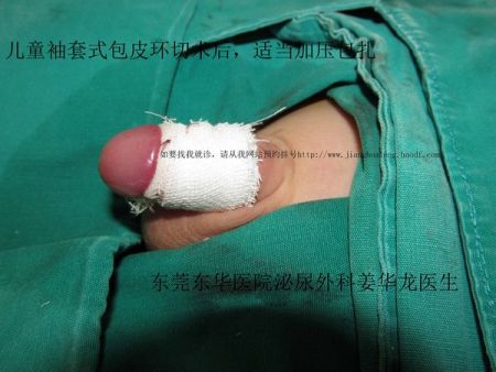 展开全部 ⑴阴茎根部皮下及两侧阴茎海绵体麻醉 ⑵尿道海绵体麻醉