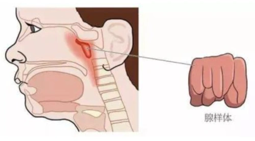 肥大的腺样体位置图