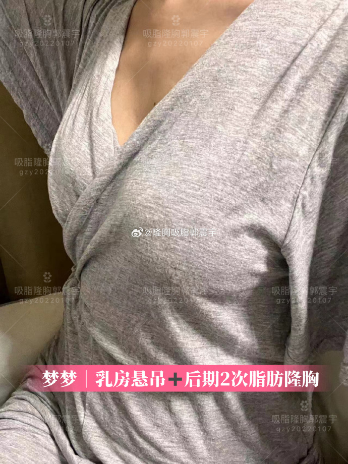 这位宝妈情况比较特殊,她二胎结束母乳喂养后,乳房萎缩空杯,中度下垂