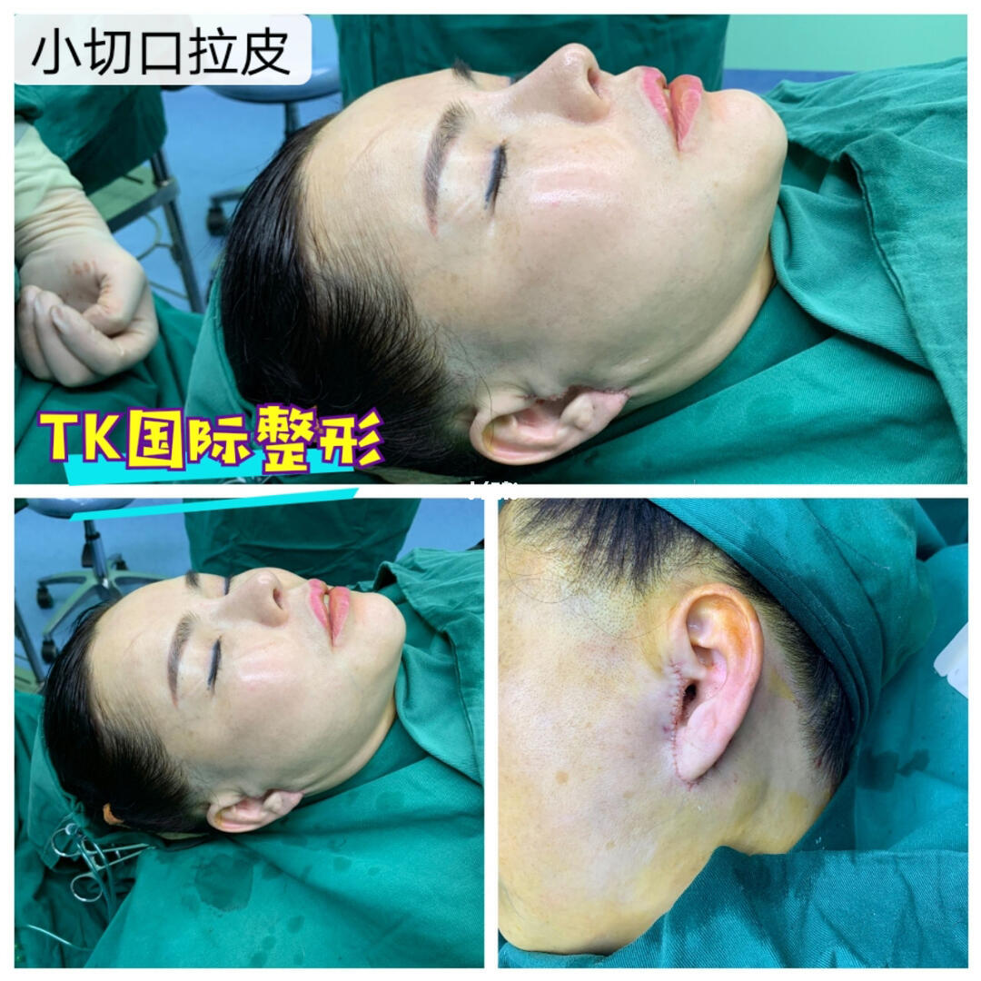 时长:38分钟"无痕小侧拉"微创提拉术:在发际线内做小切口,伤口不外露