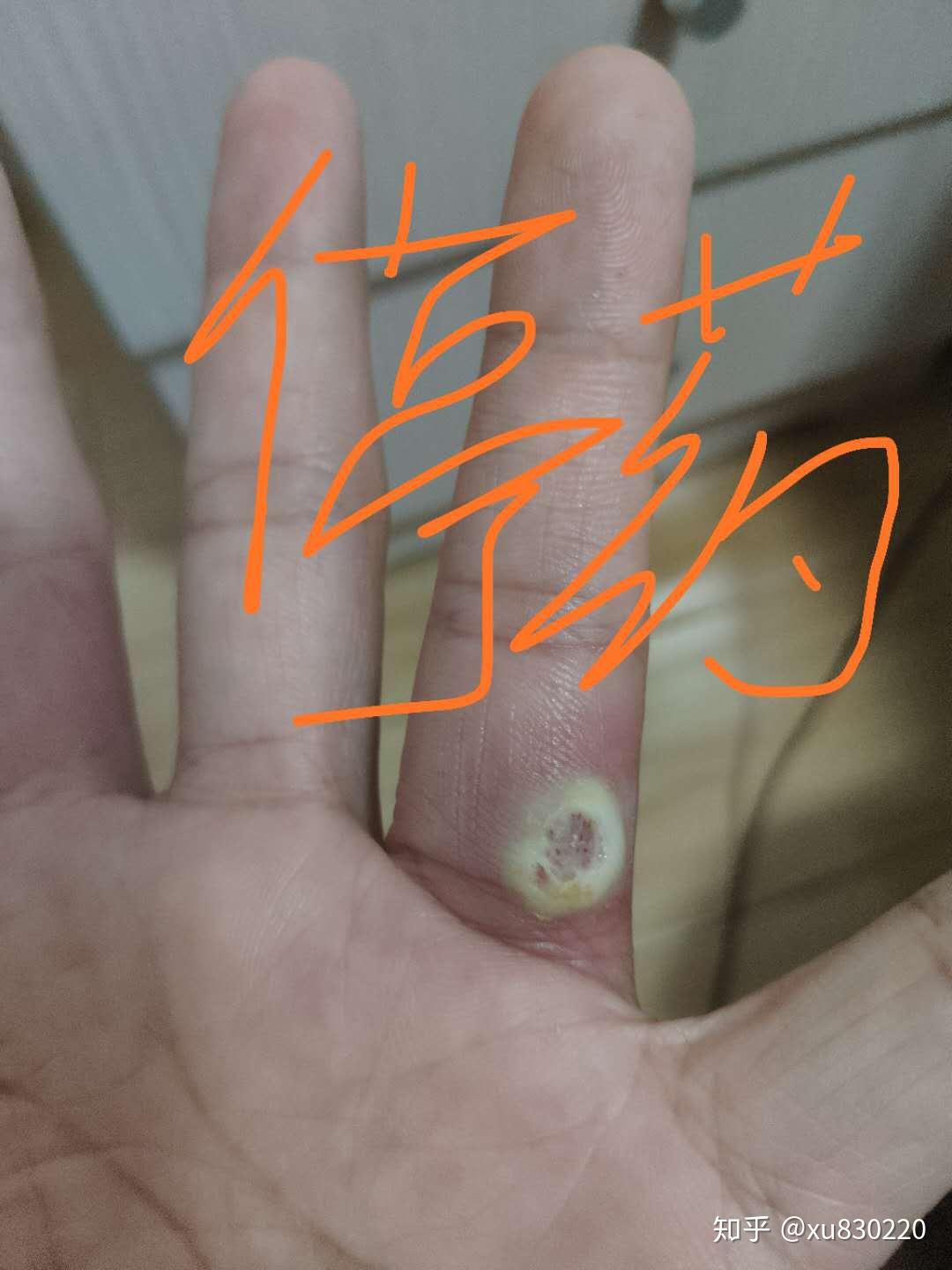 鸦胆子,把寻常疣最彻底的铲除!