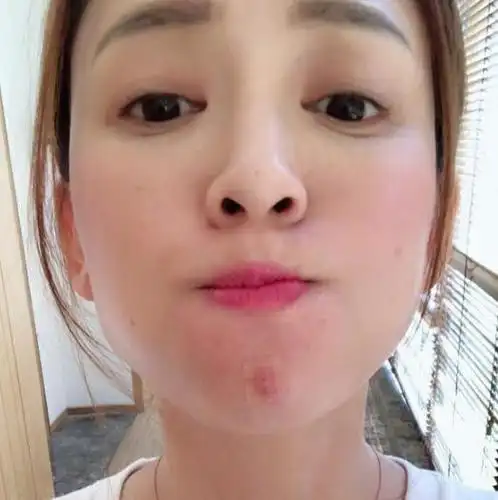 陈乔恩晒长痘自拍很无奈:痘痘我们好好聊聊呗?_明星头条网