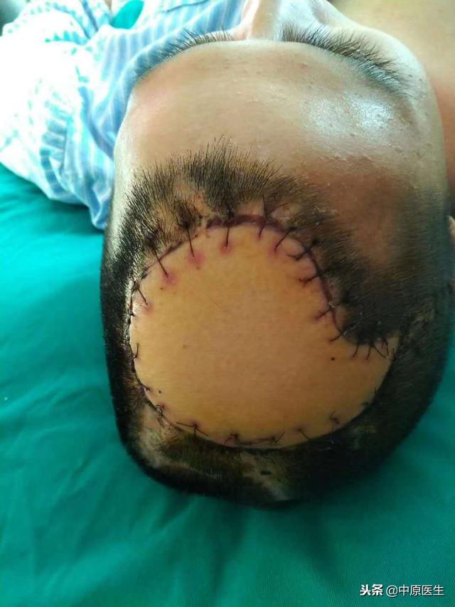 退伍士兵从建筑工地跌落一年里妻子把他当婴儿照顾,感动一群专家_颅骨