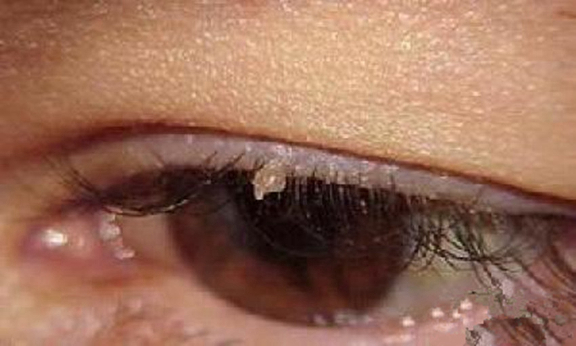 假尖锐湿疣白醋测试图片_有来医生