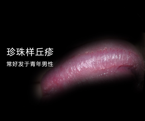 是指珍珠状阴茎丘疹,通常情况下,珍珠状阴茎丘疹不属于性病,因此男性