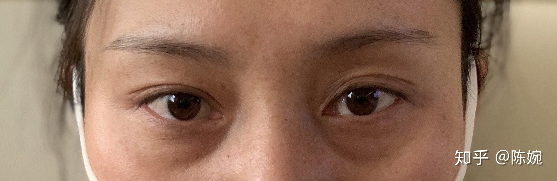 外切眼袋泪沟填充实录 - 知乎
