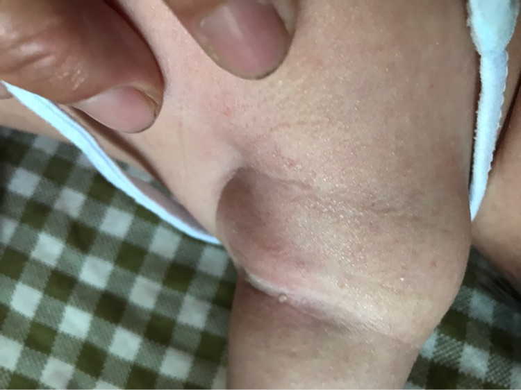 腋下起了个疙瘩