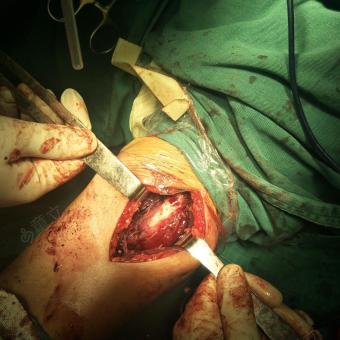 手术后诊断:左上臂脂肪瘤 病理诊断:- 手术:右上臂脂肪瘤切除术 手术