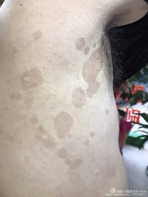 花斑癣,俗称汗斑.