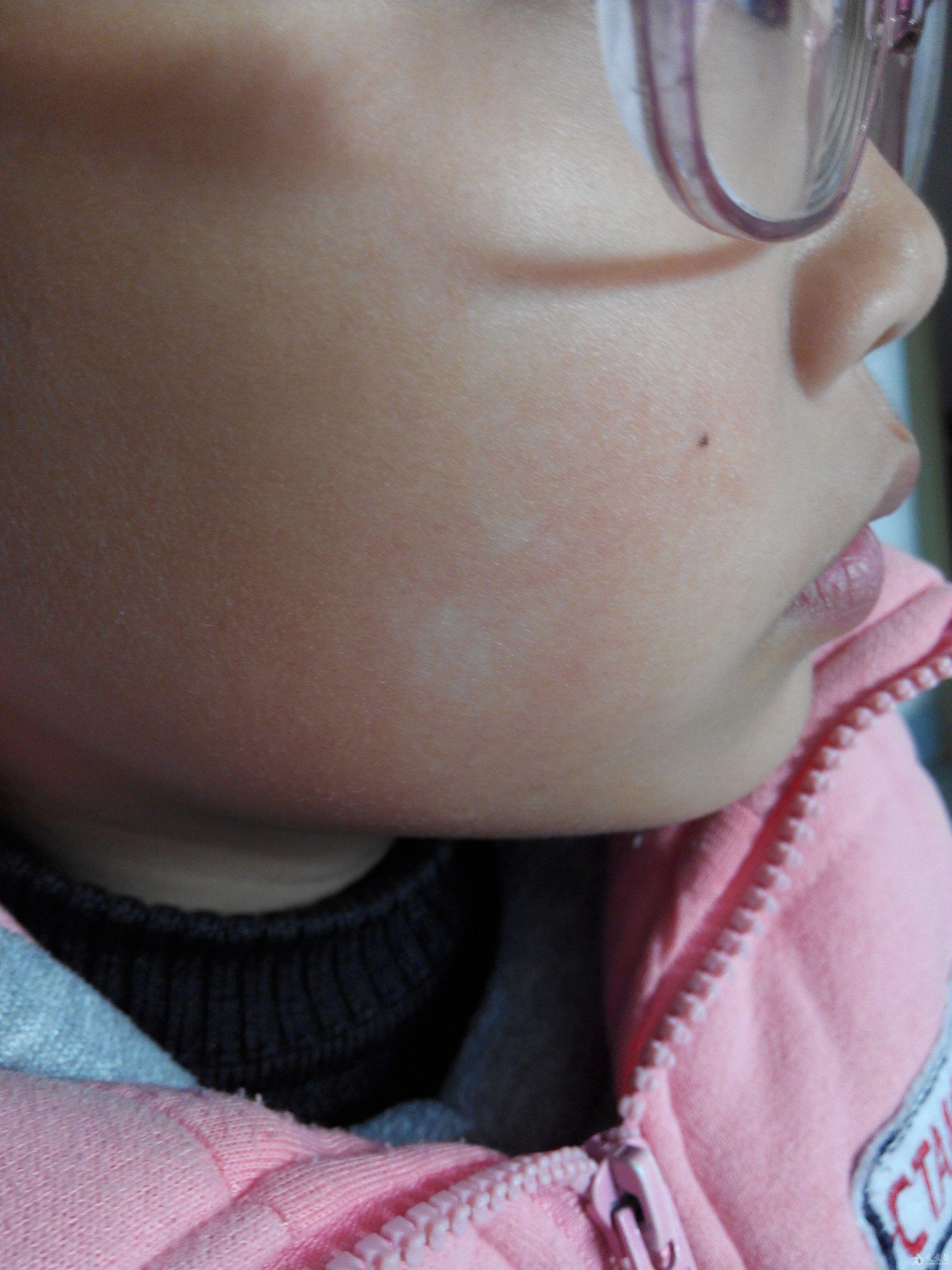 请各位老师帮忙看下,谢谢 - 皮肤及性传播疾病讨论版 - 爱爱医医学