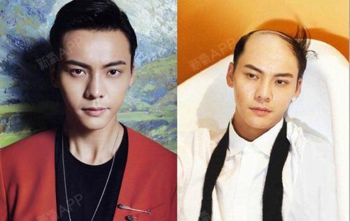 植发#植发是中年男星颜值的保鲜剂,要想40不演爹_圈子-新氧美容整形