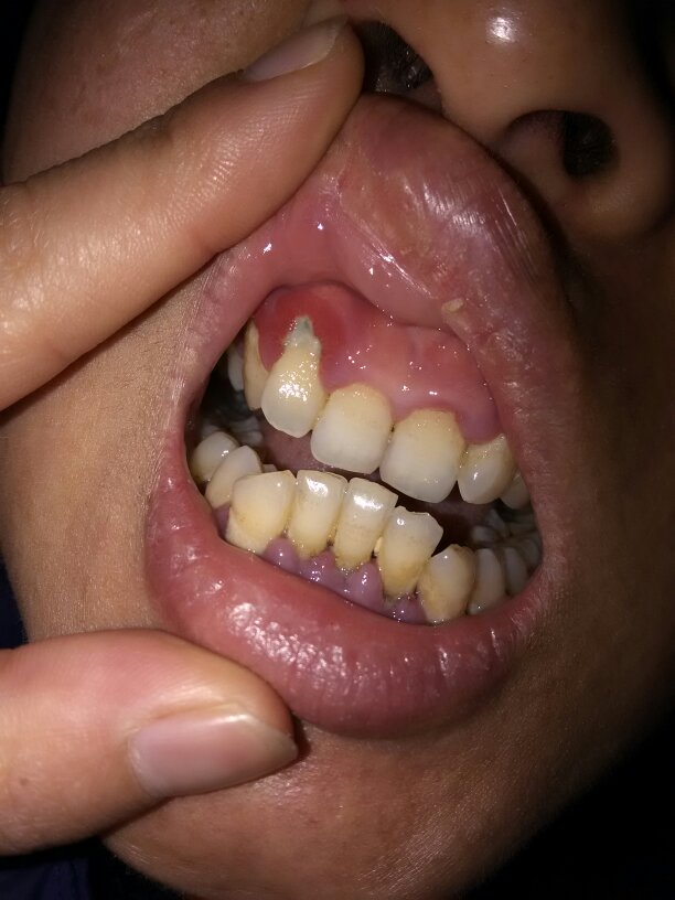 牙龈一年的问题,女,42岁,牙龈出血一年,吃了维生素c没用,现在牙床为黑