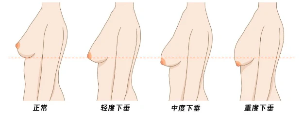 1~2cm 属于轻度下垂;乳房下垂的妇女,双侧乳房大小基本正常但皮