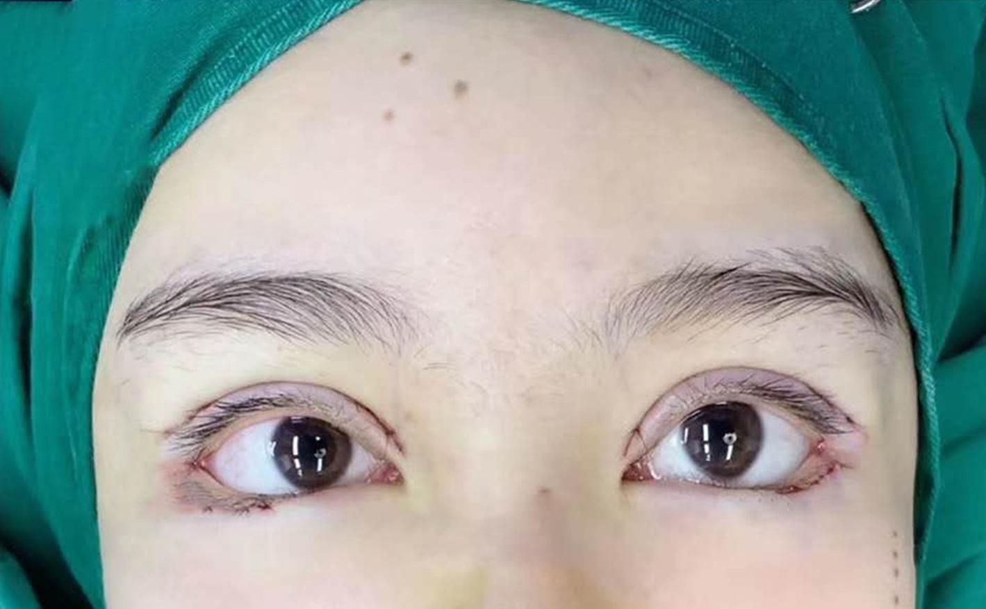 不仅仅需要将重睑线加宽这位求美者在上次手术中做了双眼皮却显得不太