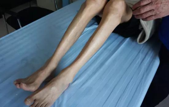 广州治疗肌肉萎缩哪家医院强