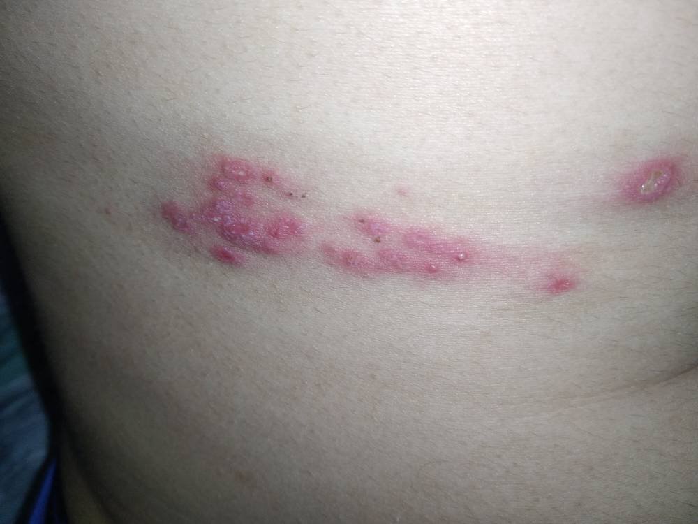 带状疱疹了,怎么回事,要多久可以好,用了抗病毒口服液和阿昔洛韦乳膏