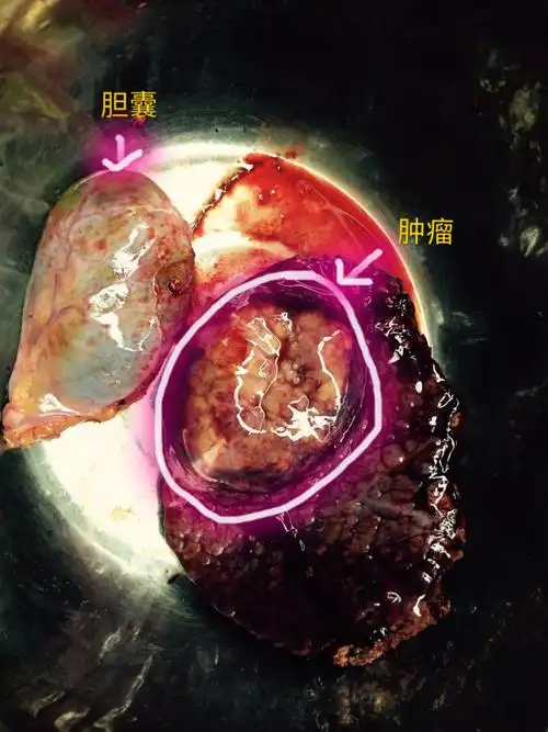 我院成功开展肝叶(肝癌)切除术