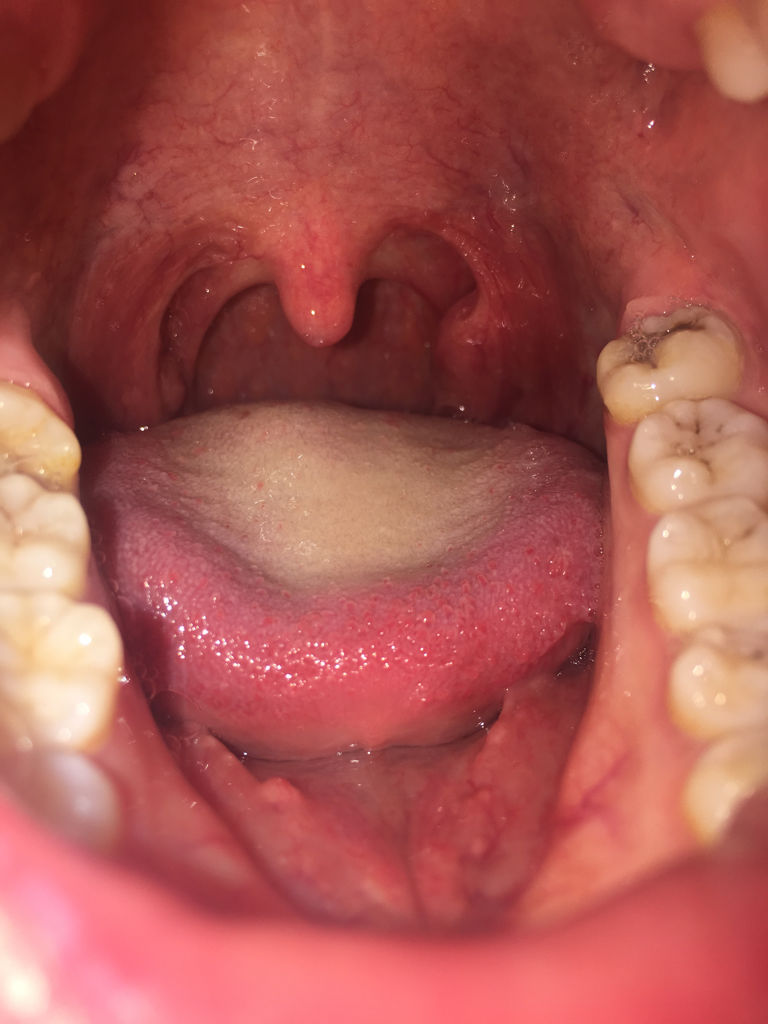 去年冬天发现的 没什么不舒服,就是一段时间会掉出白色块状的东西 还