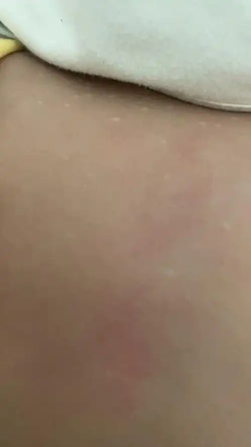 这种病情会导致皮肤表面出现小小的白点或粉刺,并且这些白点周围有