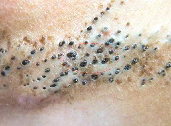 脸上螨虫怎么去除用什么药_去螨虫的最有效的药膏