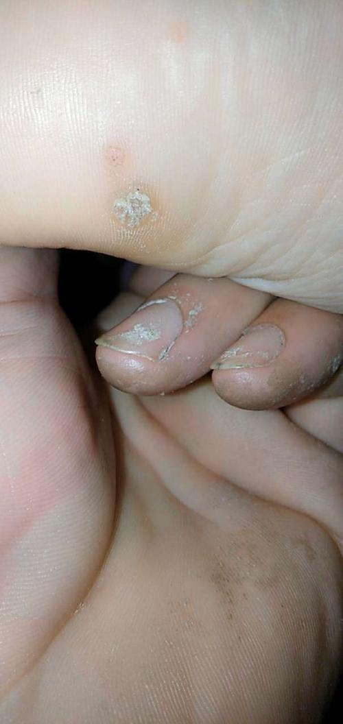 鸡眼长什么样子图片 鸡眼图片初期症状