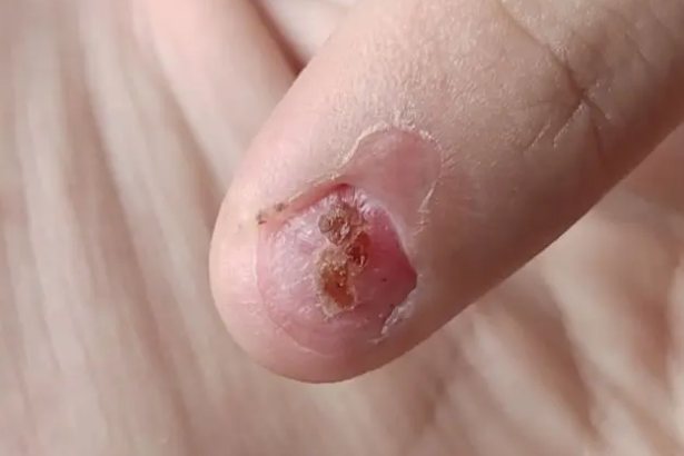 甲床结痂脱落后图片