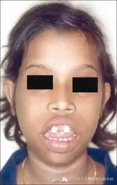 腺样体肥大的危害