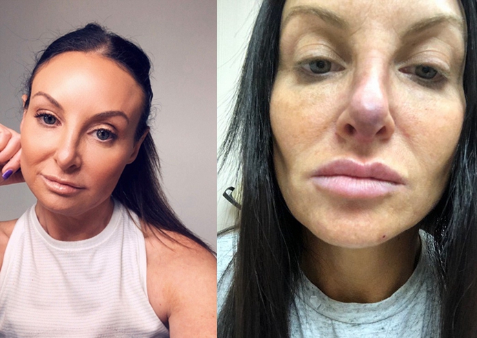 美国女子整容失败鼻子变形用水蛭治疗竟然恢复