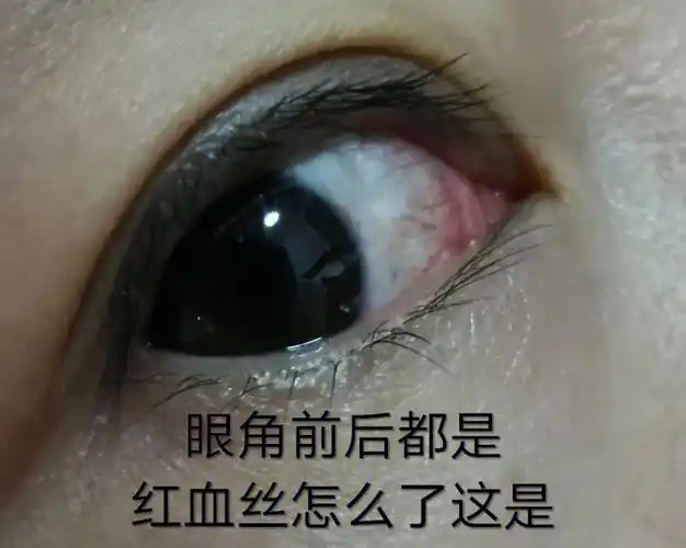 是有点不舒服,今天眼睛白眼仁的地方都是血丝,前眼角和后眼角都是这样