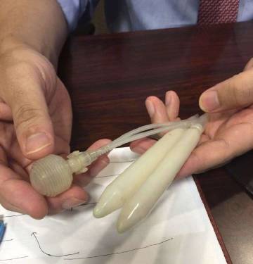 丁丁假体植入术又称支撑体植入术,是将假体或支撑体植入丁丁海绵体腔