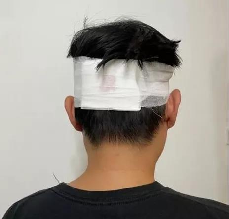 受访者李先生供图:头部受伤流血被包扎