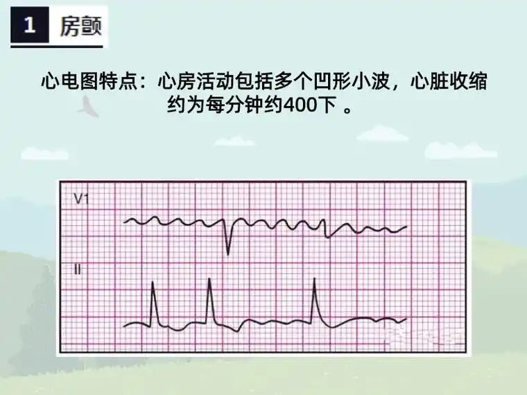 心电图各种波形特点