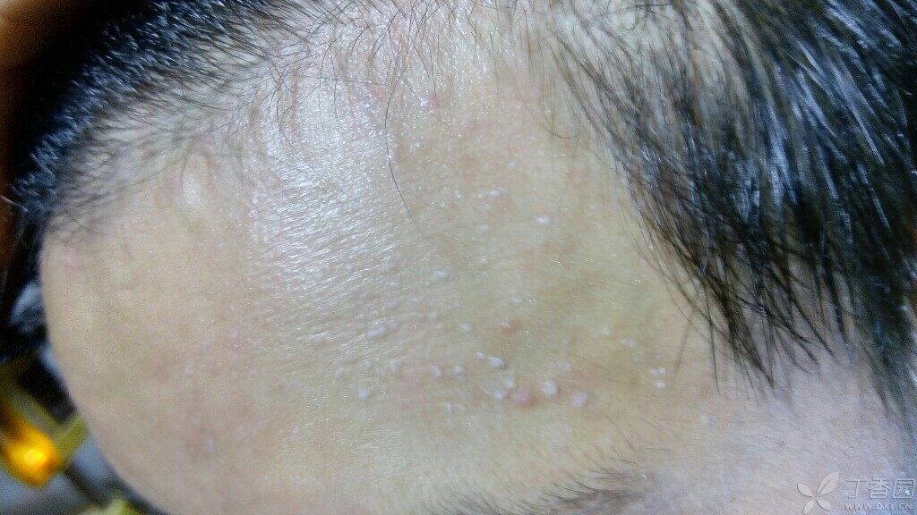 相关疾病: 疣 是脂肪粒还是疣?长在额头两侧都有是白色的