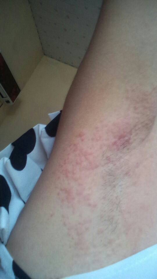 问:腋下出些这怎么回事,好痒啊,是痱子吗?