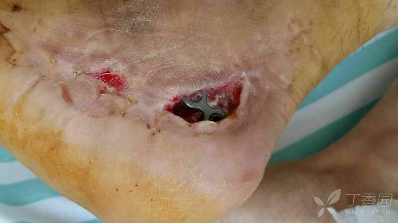 跟骨骨折术后皮缘坏死保守治疗一例 [病例帖]